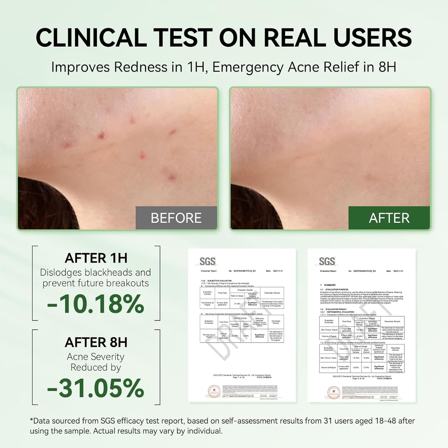 LANBENA 2% Salicylic Acid Spot Serum, 8H Rapid Acne Treatment for Acne-Prone Sensitive Skin, Fast-Acting Dry Out Pimples, Fade Acne Marks, Redness Relief, Overnight & Period Breakouts, 0.42 Fl Oz