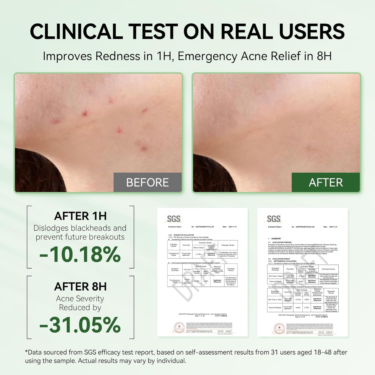 LANBENA 2% Salicylic Acid Spot Serum, 8H Rapid Acne Treatment for Acne-Prone Sensitive Skin, Fast-Acting Dry Out Pimples, Fade Acne Marks, Redness Relief, Overnight & Period Breakouts, 0.42 Fl Oz
