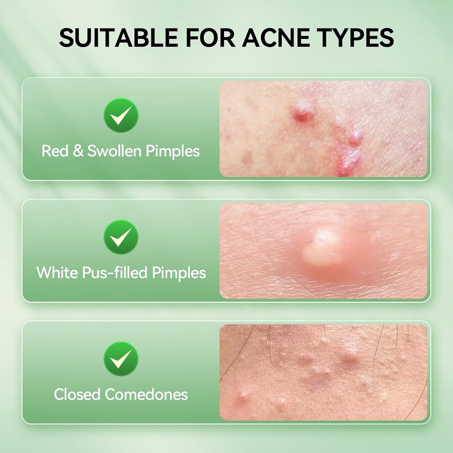 LANBENA 2% Salicylic Acid Spot Serum, 8H Rapid Acne Treatment for Acne-Prone Sensitive Skin, Fast-Acting Dry Out Pimples, Fade Acne Marks, Redness Relief, Overnight & Period Breakouts, 0.42 Fl Oz